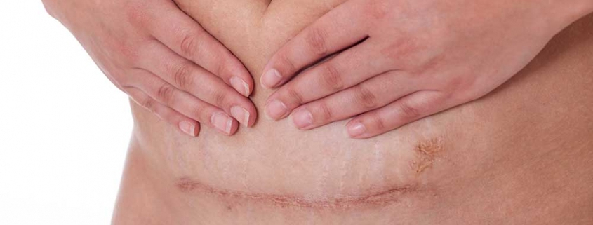 A person with scars on their abdomen and hands.
